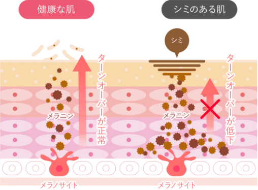 健康な肌とシミのある肌