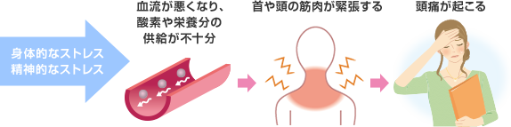 緊張型頭痛の原因とメカニズムの図説