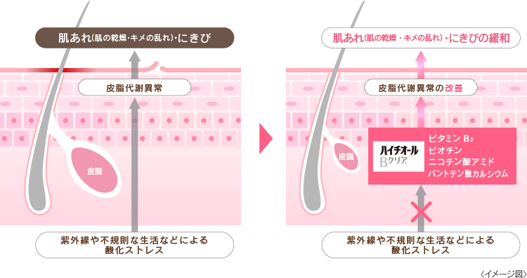 皮脂の代謝異常と改善