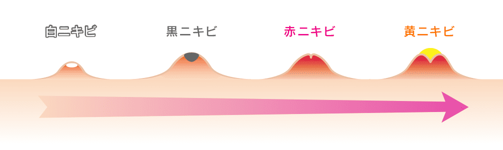 ニキビの種類のイメージ図