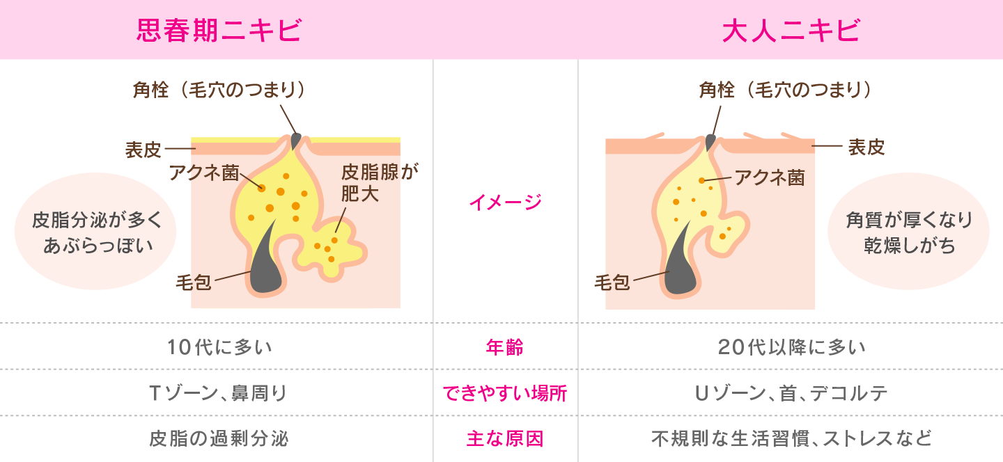 思春期ニキビと大人ニキビは原因が違う ハイチオール エスエス製薬