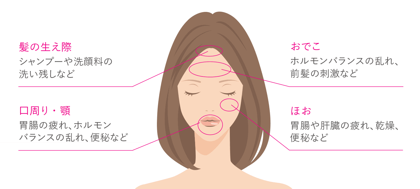 肌荒れとは 肌荒れの症状を知る ハイチオール エスエス製薬