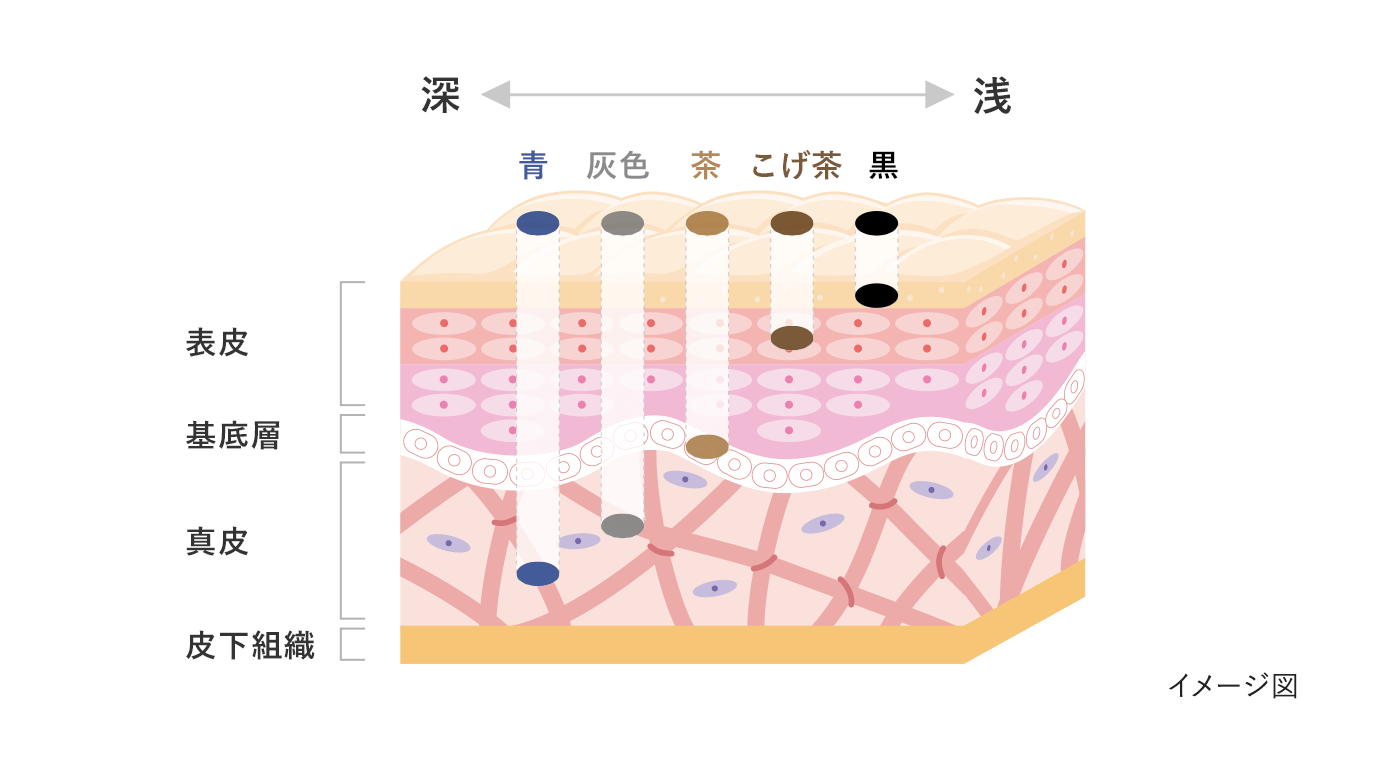 色調でわかるシミ 色素沈着 の深さ ハイチオール エスエス製薬