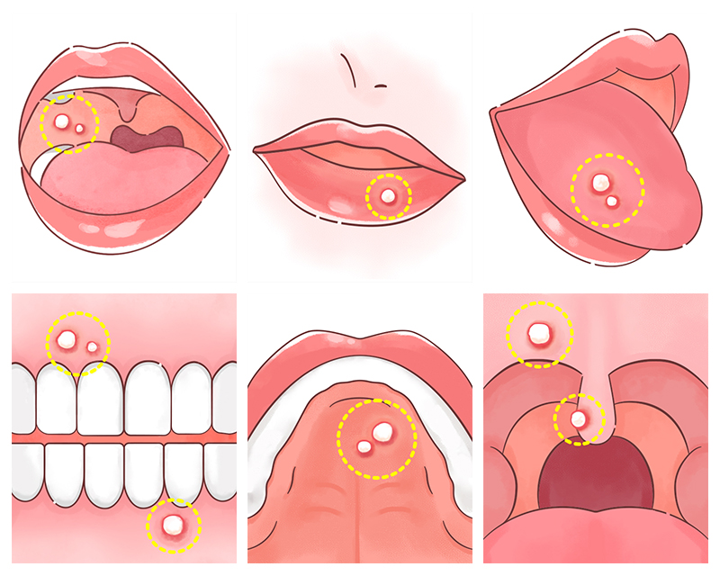 口内炎ができやすい場所のイメージ