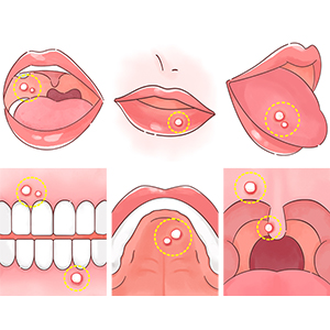 口内炎ができる理由と症状