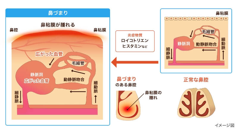 鼻粘膜の腫れが鼻づまりを引き起こすイメージ図